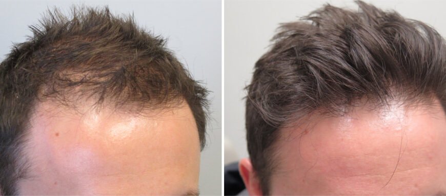 Minoxidil vs. Finasteride