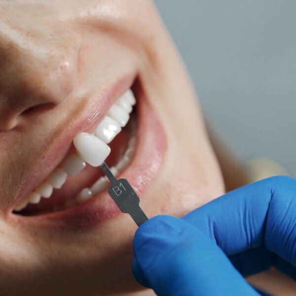 Zirconia Crown