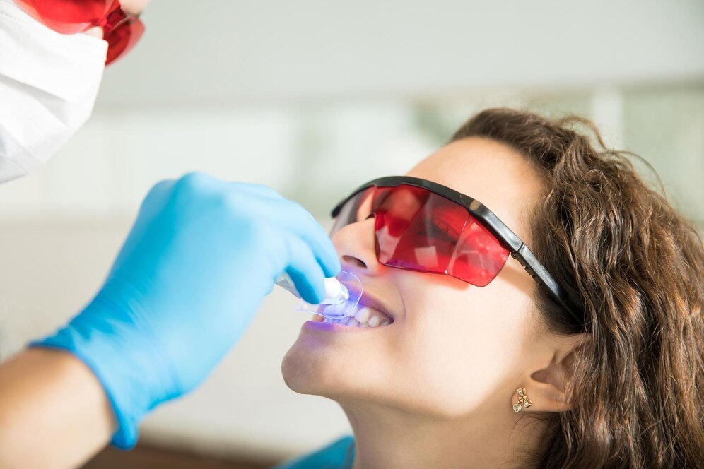 Cosmetic Bonding 101
