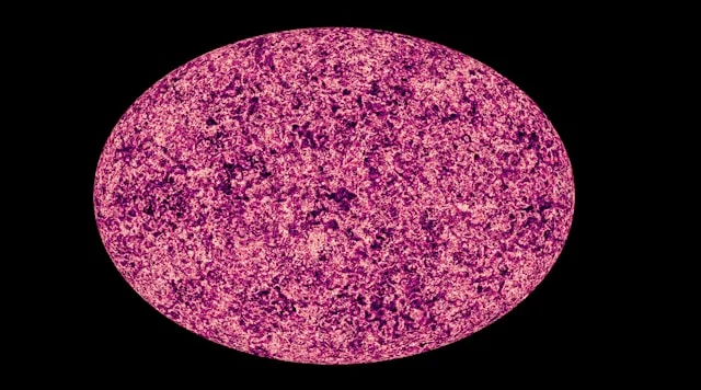 melanoma