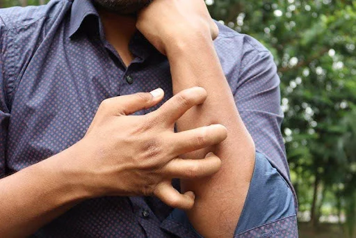 Skin Irritation
