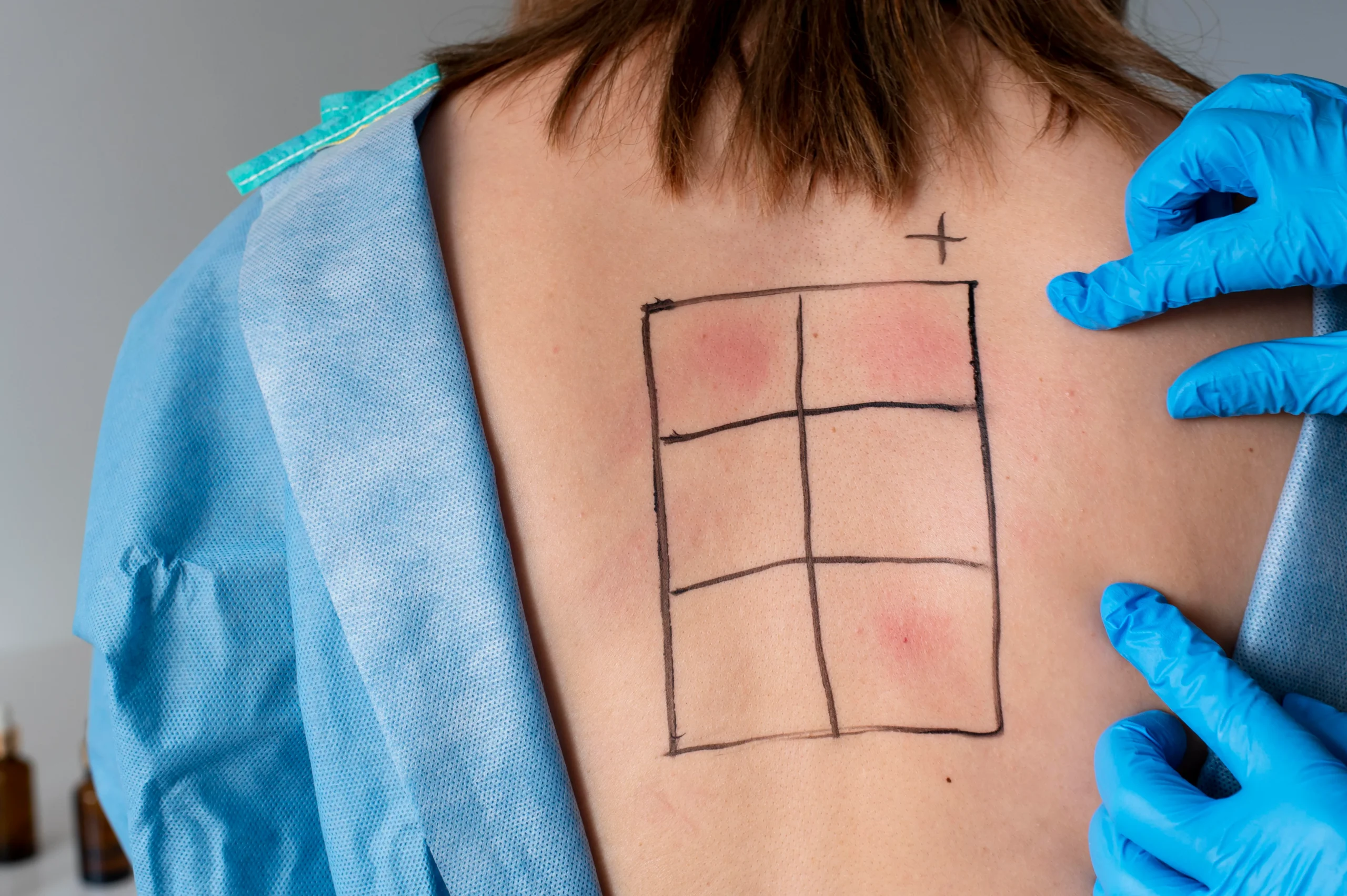Keloid Treatment