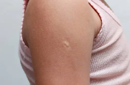 Keloid Scars: Understanding, Managing, and Treating Them